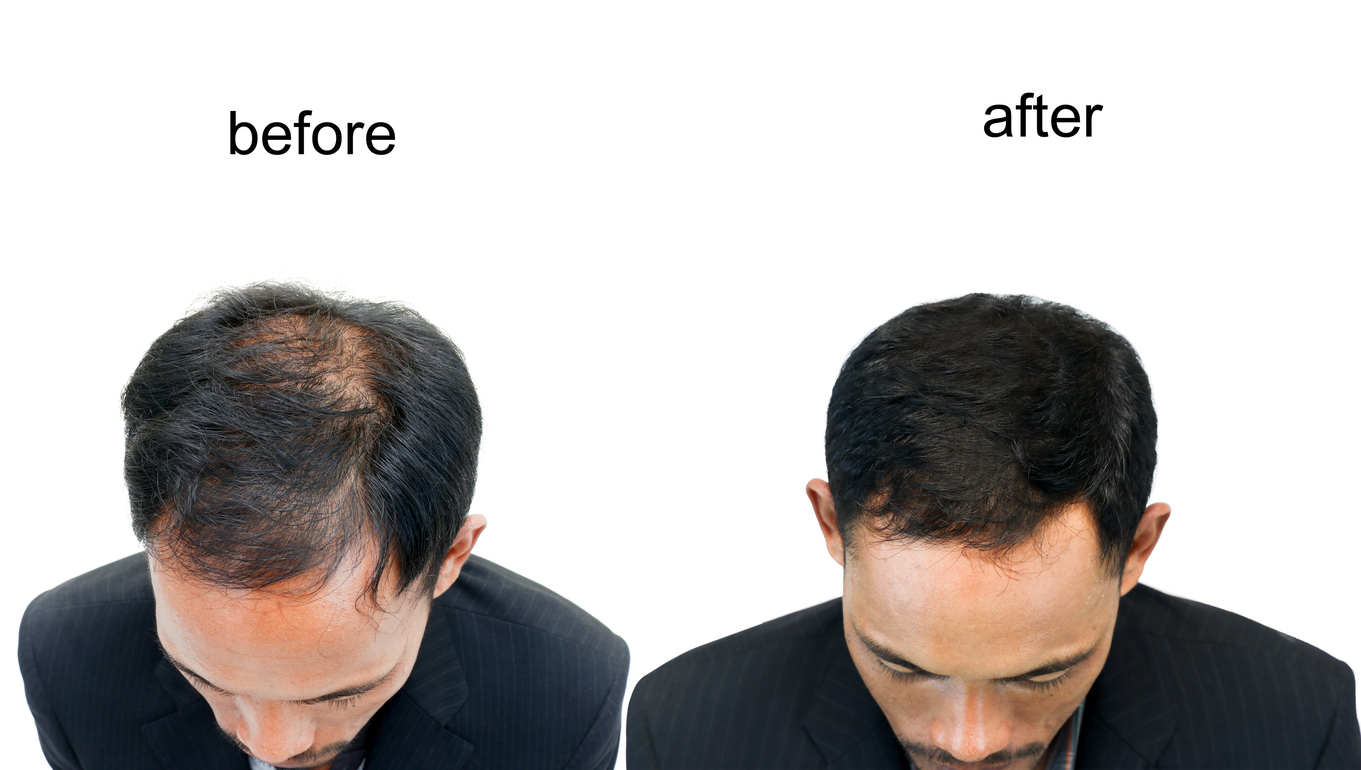 before-and-after-bald-head